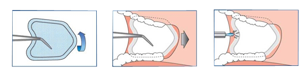 NeoDrys Reflective Pedo Small 50/pk. - Microcopy