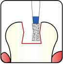 Diabolo 1.4 mm Dia. Medium Grit Diamond Bur 5 per pack. 032.14M1