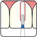 Cylindrical 1 mm Dia. Medium Grit Diamond Bur 5 per pack. 107.10M1