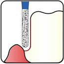 Cylindrical, Hemispherical End 2 mm Dia. Fine Grit Diamond Bur 5 per pack. 137.20F1 - Osung USA