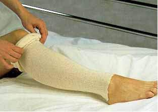 Alba Non-Sterile Stockinette Stockinette Tubular Nscot 3X25Yds 20Rl/Cs -81322