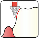 Interdental Bur 1.6 mm Dia. Fine Grit Diamond Bur 5 per pack. 465.16F1