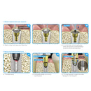 Osung Dental Screw Removal Kit -OSR-KIT - Osung USA