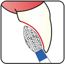 Bud, Slender 1.8 mm Dia. Medium Grit Diamond Bur 5 per pack. 257.18M1