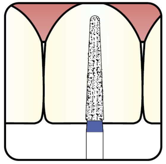 Conical, Dome End 1.2 mm Dia. Fine Grit Diamond Bur 5 per pack. 194.12F2