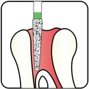 Conical End, Dome End Side Cutting Only 1.6 mm Dia. Coarse Grit Diamond Bur 5 per pack. 215.16C1