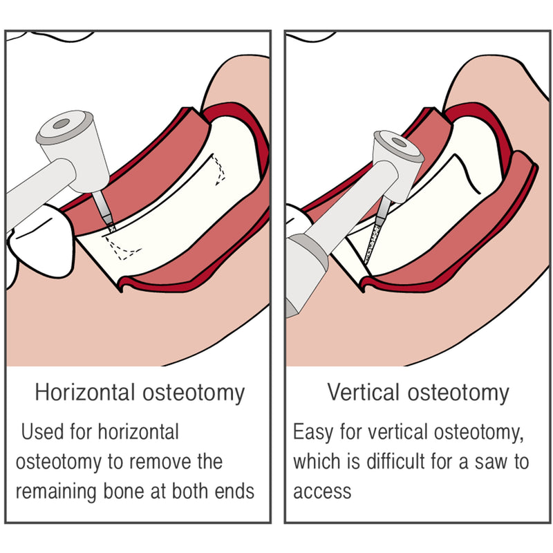 Osung Ridge Split Bur 10mm -RSBTRM - Osung USA